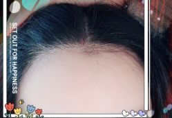 -大麦微针植发全国连锁