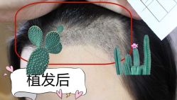 -大麦微针植发全国连锁