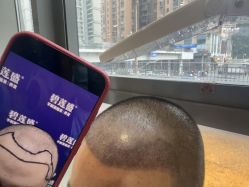 -碧莲盛·不剃发植发