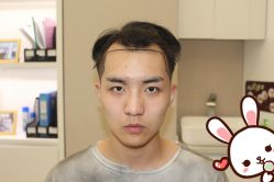 点击看大图 -大麦微针植发丨全国连锁