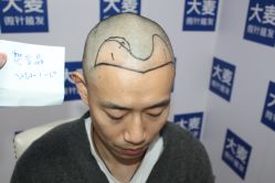 -大麦微针植发丨全国连锁