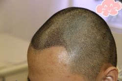 -大麦微针植发丨全国连锁