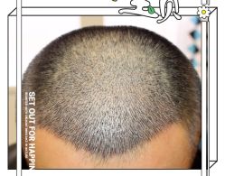 -大麦微针植发全国连锁