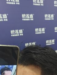 -碧莲盛·不剃发植发