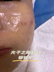体验前-北京叶子整形美容医院
