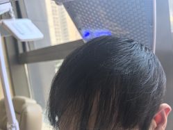 -碧莲盛·不剃发植发