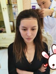 点击看大图 -大麦微针植发丨全国连锁