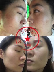 -美丽人生祛斑扁平疣汗管瘤中心