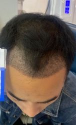 -大麦微针植发丨全国连锁