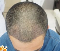 -大麦微针植发丨全国连锁