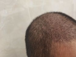 -碧莲盛·不剃发植发