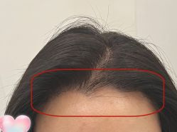 -大麦微针植发全国连锁