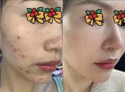 -成都苗方清颜专业祛痘