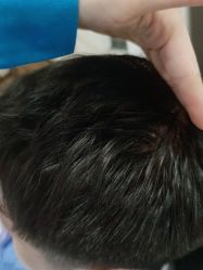 点击看大图 -碧莲盛·不剃发植发
