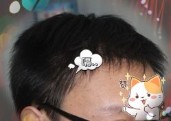 -大麦微针植发全国连锁