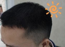 -大麦微针植发丨全国连锁