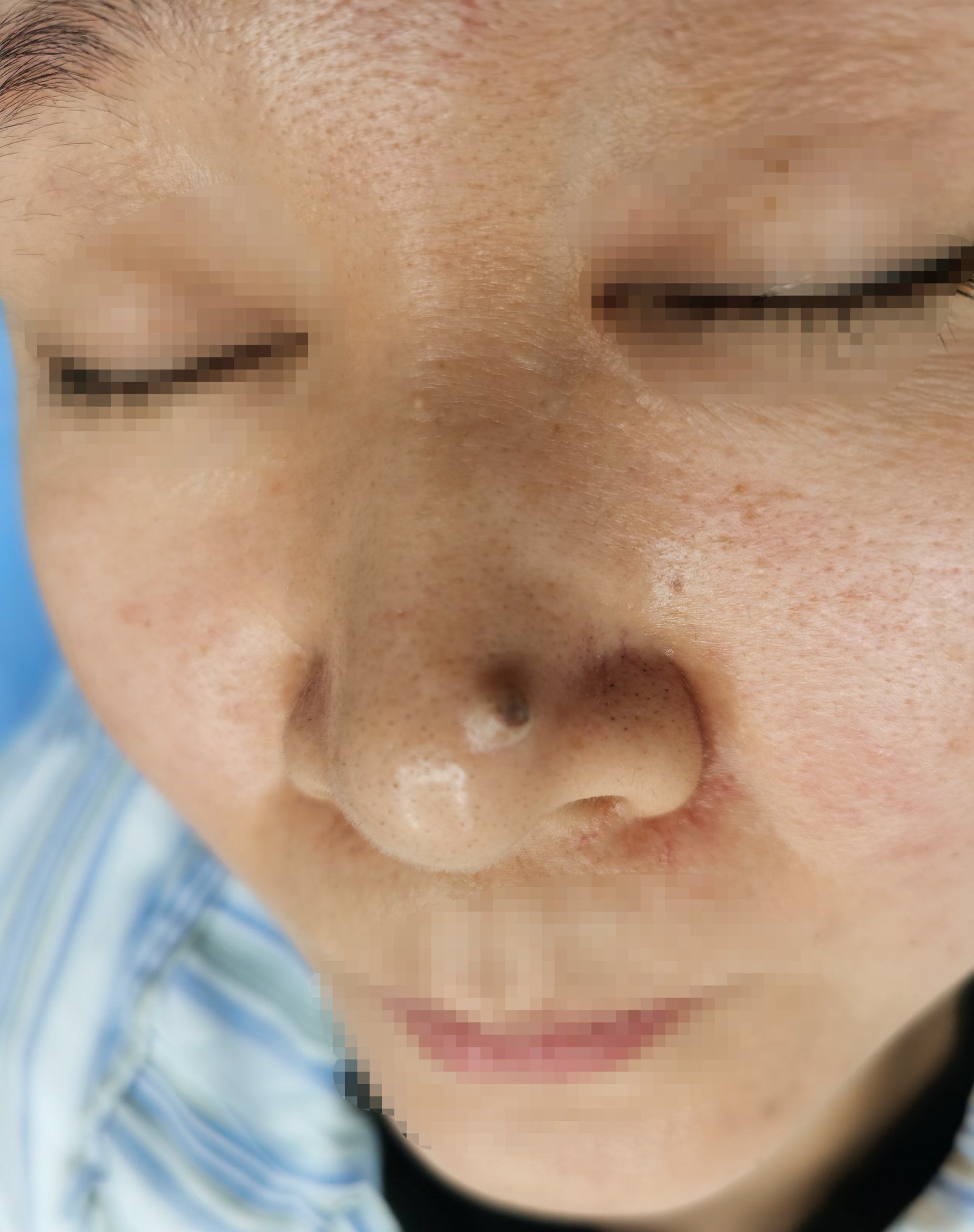 今天的门诊手术中有一台是鼻头黑痣切除,看