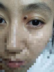 -北京美痣堂古方祛痣斑疣瘊