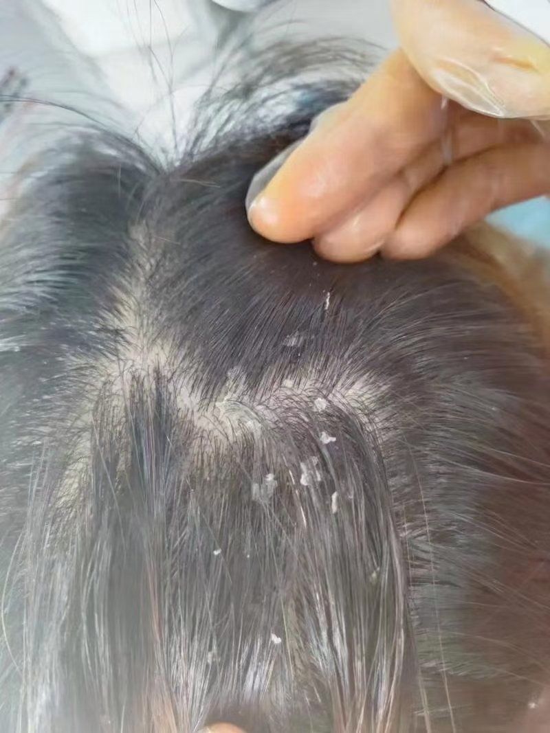 头皮常见的问题
