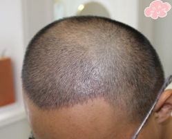 -大麦微针植发丨全国连锁