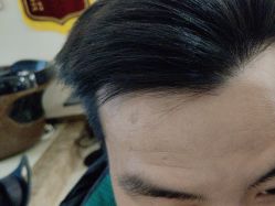 -碧莲盛·不剃发植发