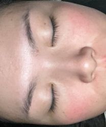 体验后-素美医疗美容·西南眼鼻整形·修复基地