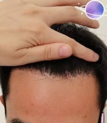 -大麦微针植发丨全国连锁