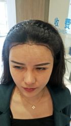 -大麦微针植发丨全国连锁