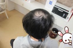 -大麦微针植发丨全国连锁