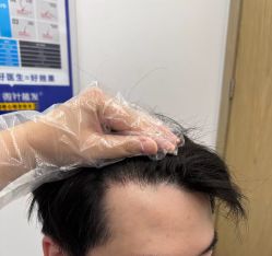 -大麦微针植发全国连锁