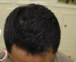 -大麦微针植发丨全国连锁