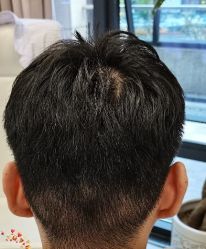 -大麦微针植发丨全国连锁