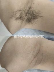 -薇兰专业脱毛连锁机构