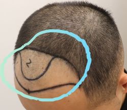 点击看大图 -大麦微针植发全国连锁