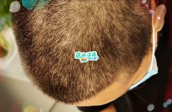 -大麦微针植发全国连锁