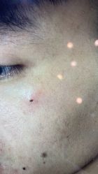 -痣斑堂·取大痣