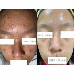 -美肤盾祛痘·问题肌头疗管理中心