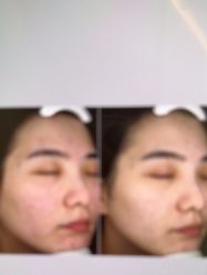 -苑苑vbeauty科技美容SPA