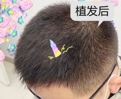 -大麦微针植发全国连锁