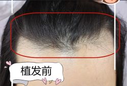 -大麦微针植发全国连锁