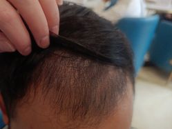 -碧莲盛·不剃发植发