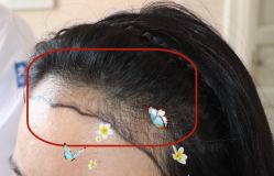 -大麦微针植发全国连锁