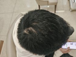 -大麦微针植发全国连锁