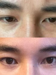 体验后-紫洁俪方（北京）医疗美容