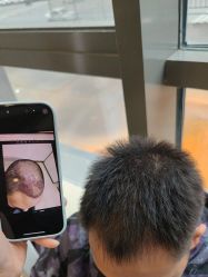 -碧莲盛·不剃发植发