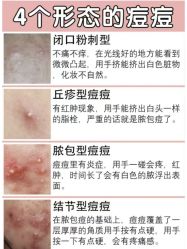 -苗方清颜专业祛痘连锁机构