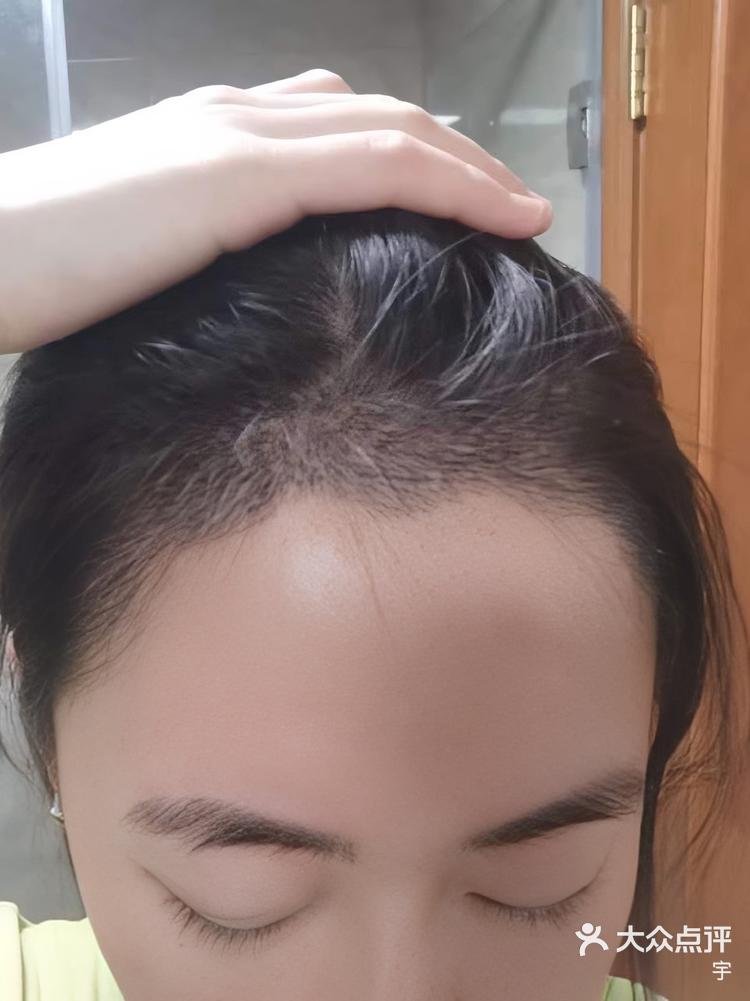 植发后半年了植发区痛(植发半年了还是感觉很少)