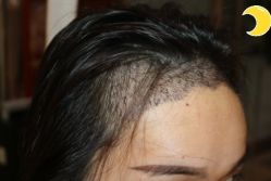 -大麦微针植发丨全国连锁