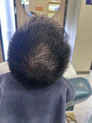 -大麦微针植发丨全国连锁