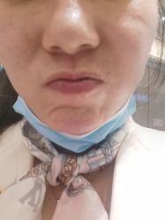 体验后-More摩尔医美の注射线雕光电中心